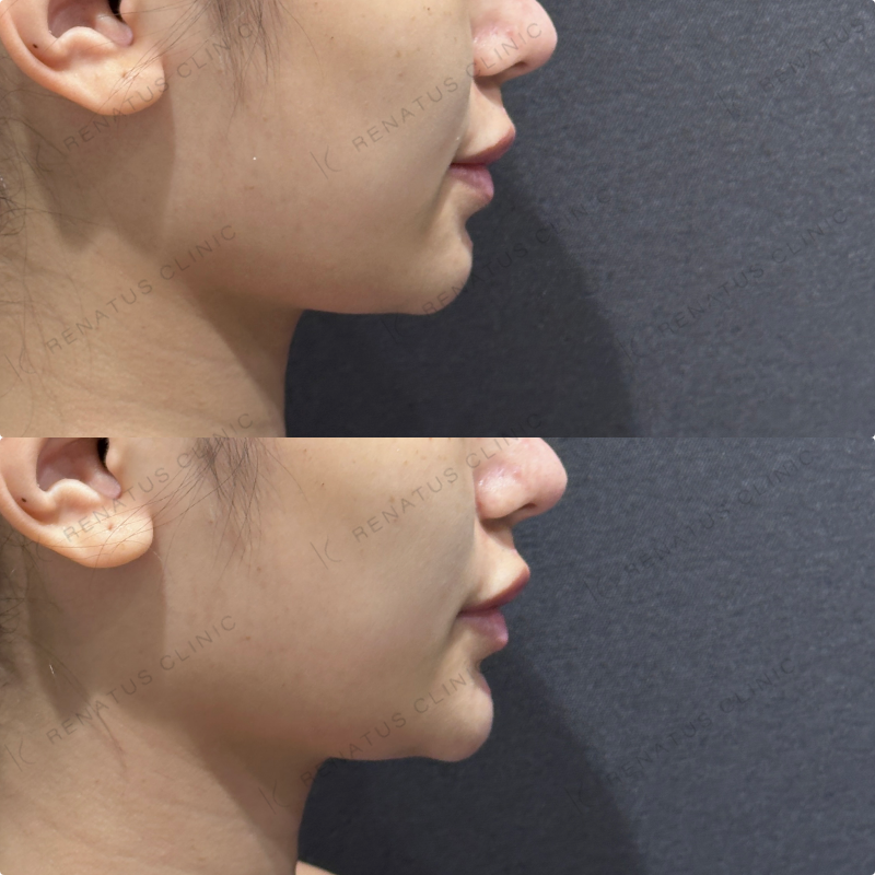 顎ヒアルロン酸ボラックス症例写真