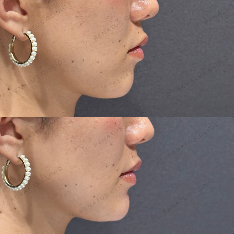 顎ヒアルロン酸ボラックス症例写真