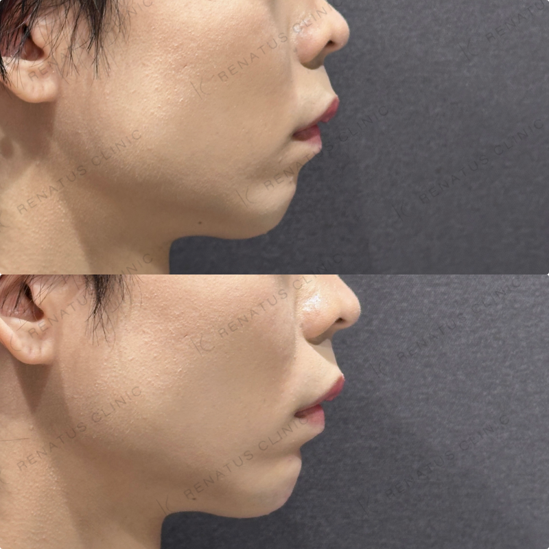 顎ヒアルロン酸ボラックス症例写真