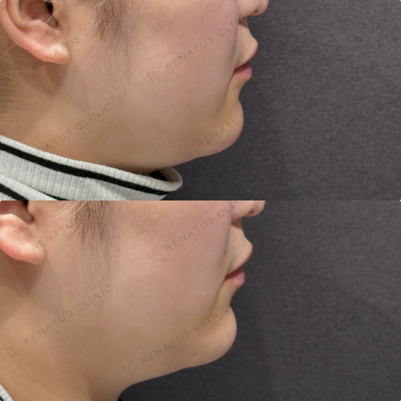 顎ヒアルロン酸ボラックス症例写真