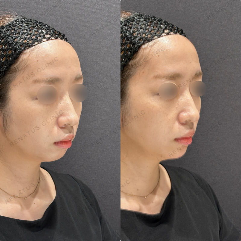 顎ヒアルロン酸ボラックス症例写真