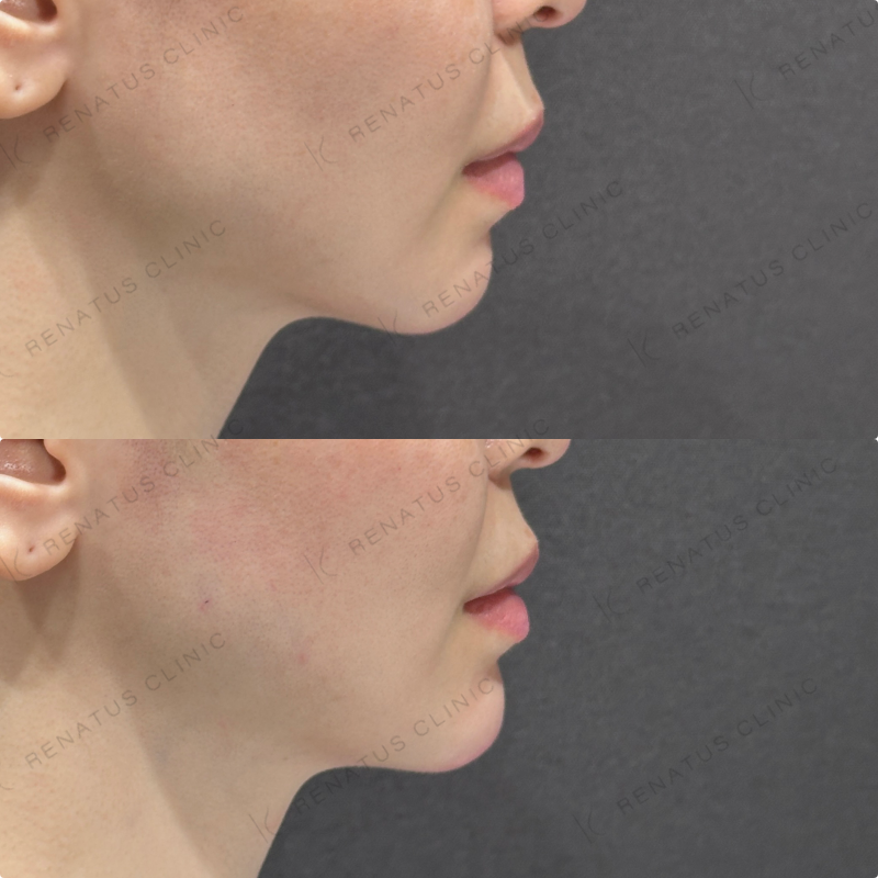 顎ヒアルロン酸ボラックス症例写真