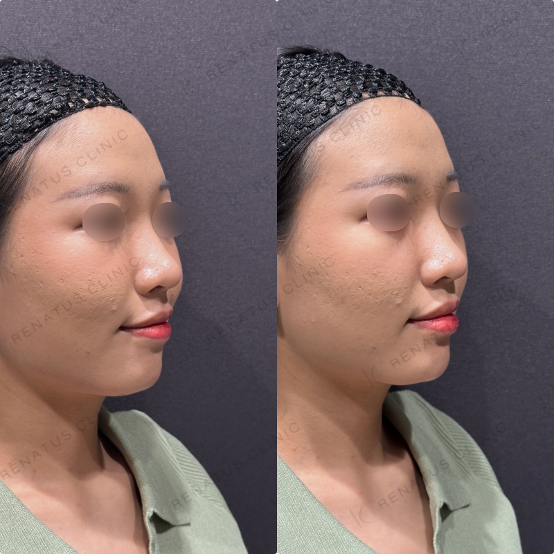 顎ヒアルロン酸ボラックス症例写真