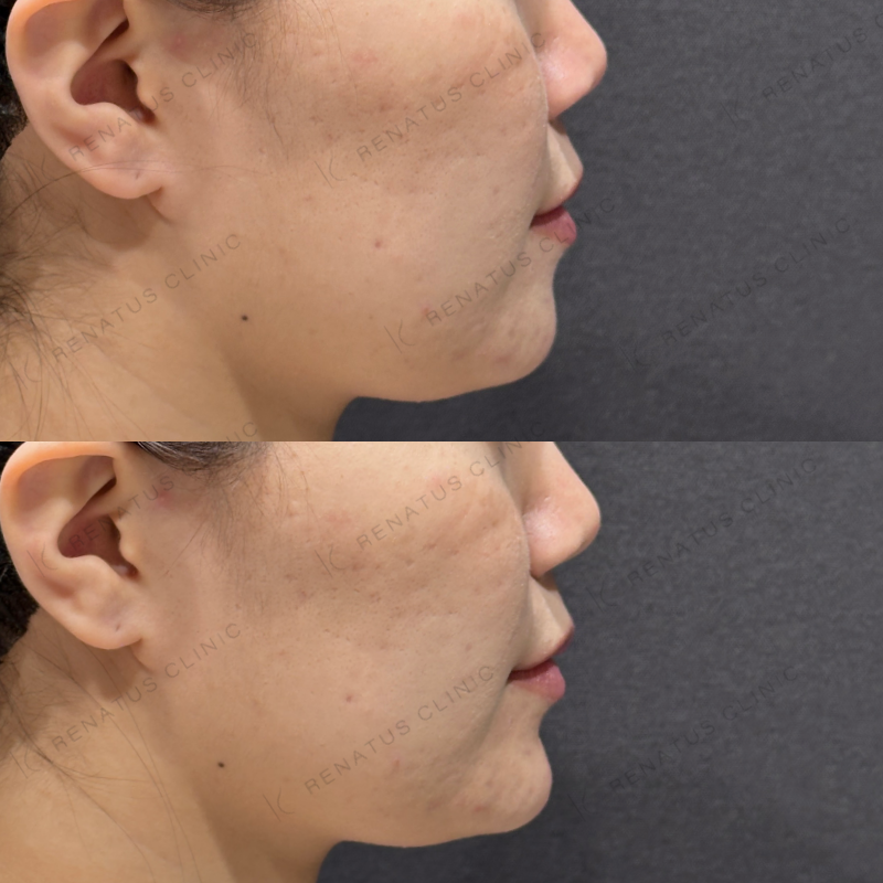 顎ヒアルロン酸ボラックス症例写真