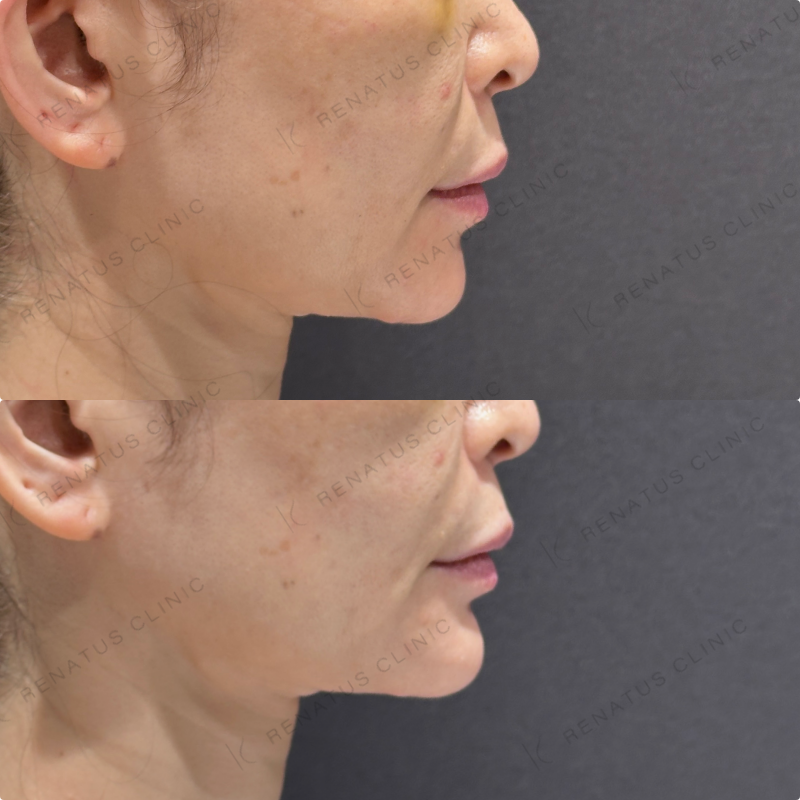 顎ヒアルロン酸ボラックス症例写真