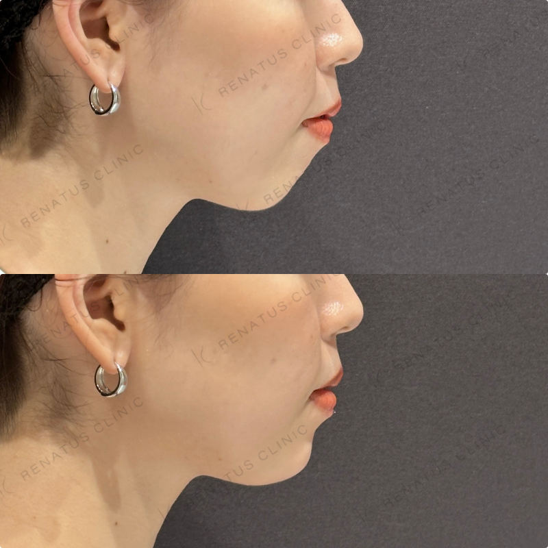 顎ヒアルロン酸ボラックス症例写真
