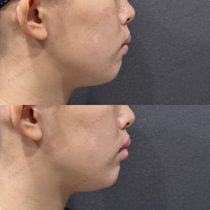 顎ヒアルロン酸ボラックス症例写真