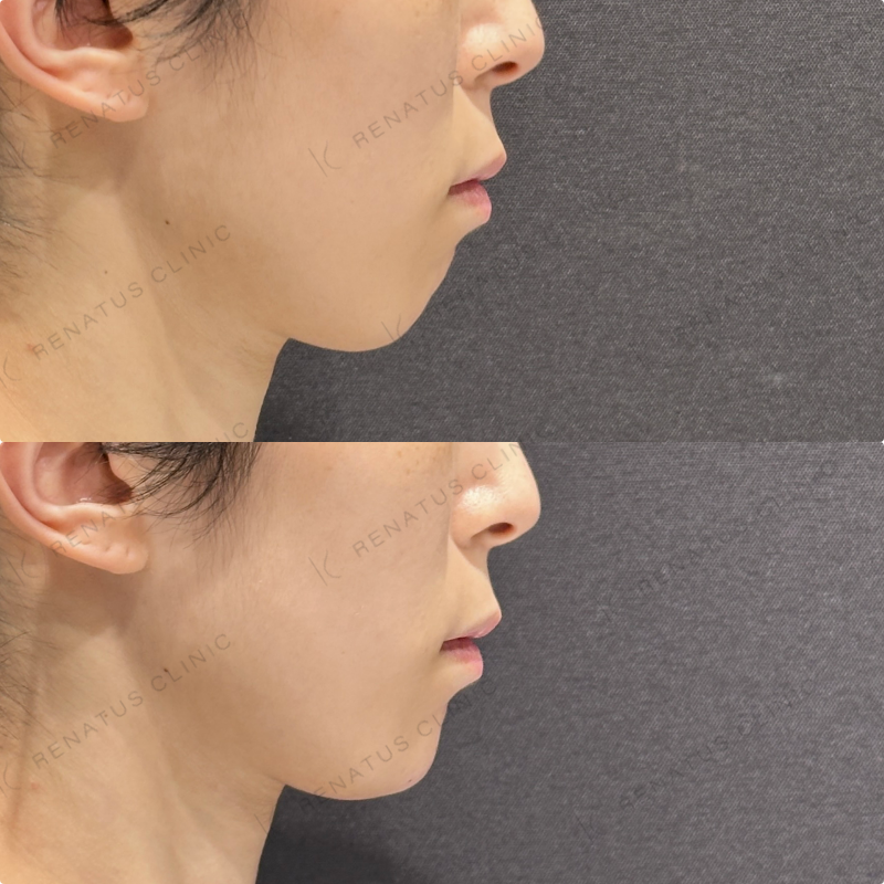 顎ヒアルロン酸ボラックス症例写真