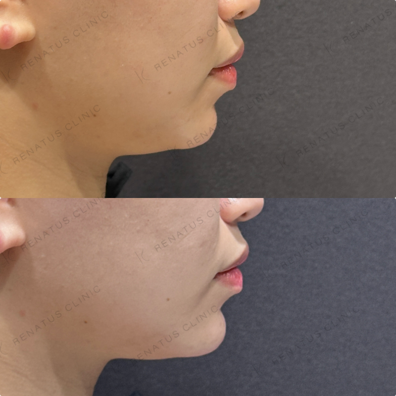 顎ヒアルロン酸ボラックス症例写真