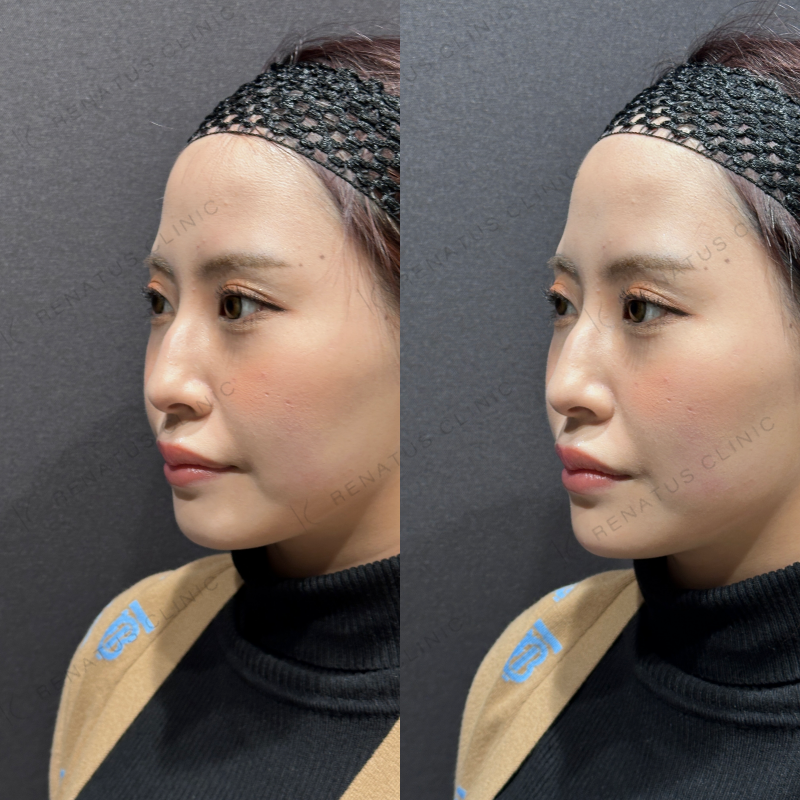 顎ヒアルロン酸ボラックス症例写真