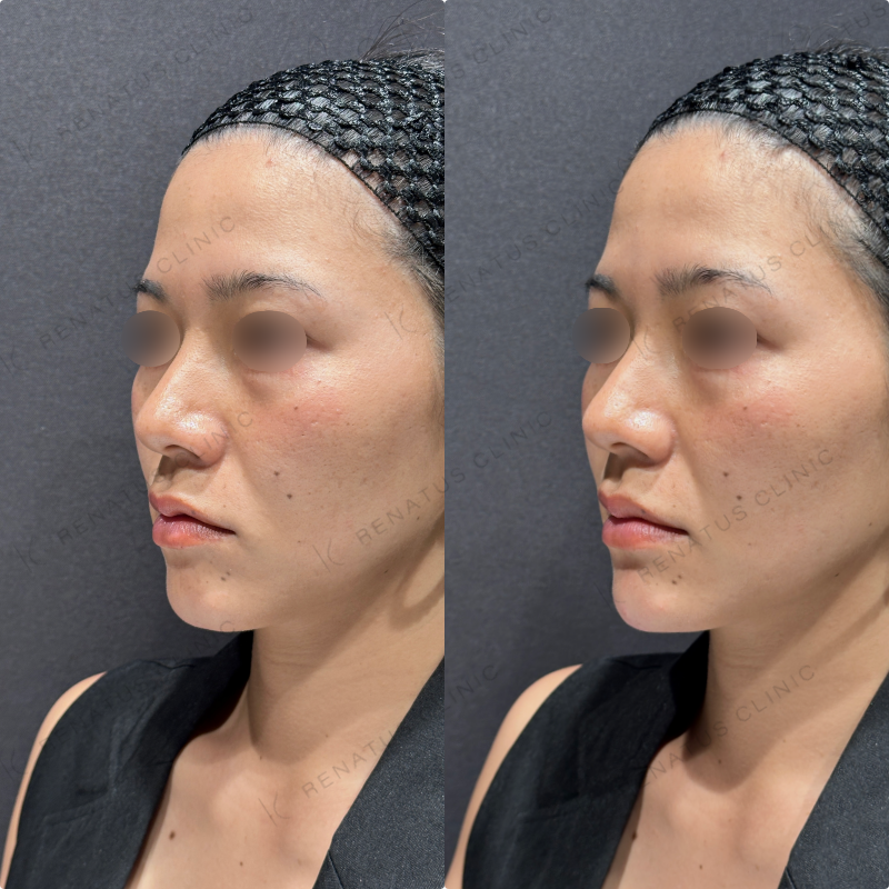 顎ヒアルロン酸ボラックス症例写真