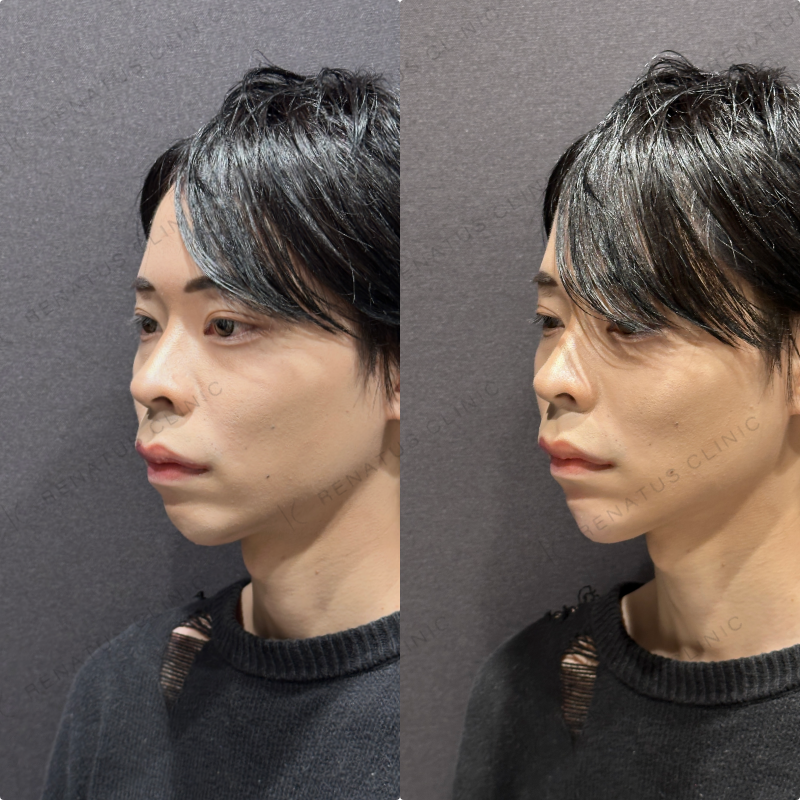 顎ヒアルロン酸ボラックス症例写真