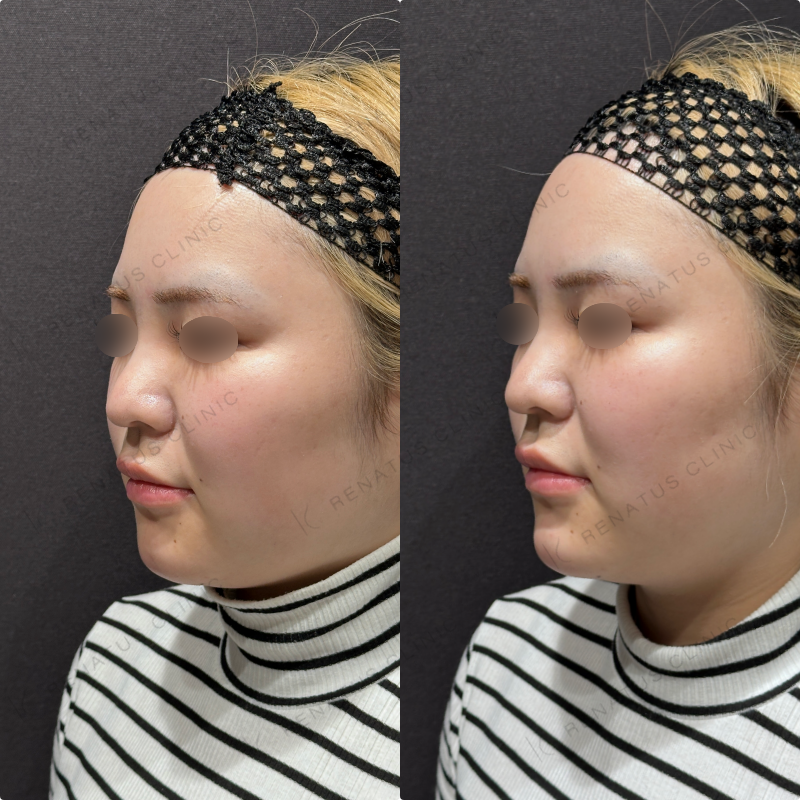 顎ヒアルロン酸ボラックス症例写真