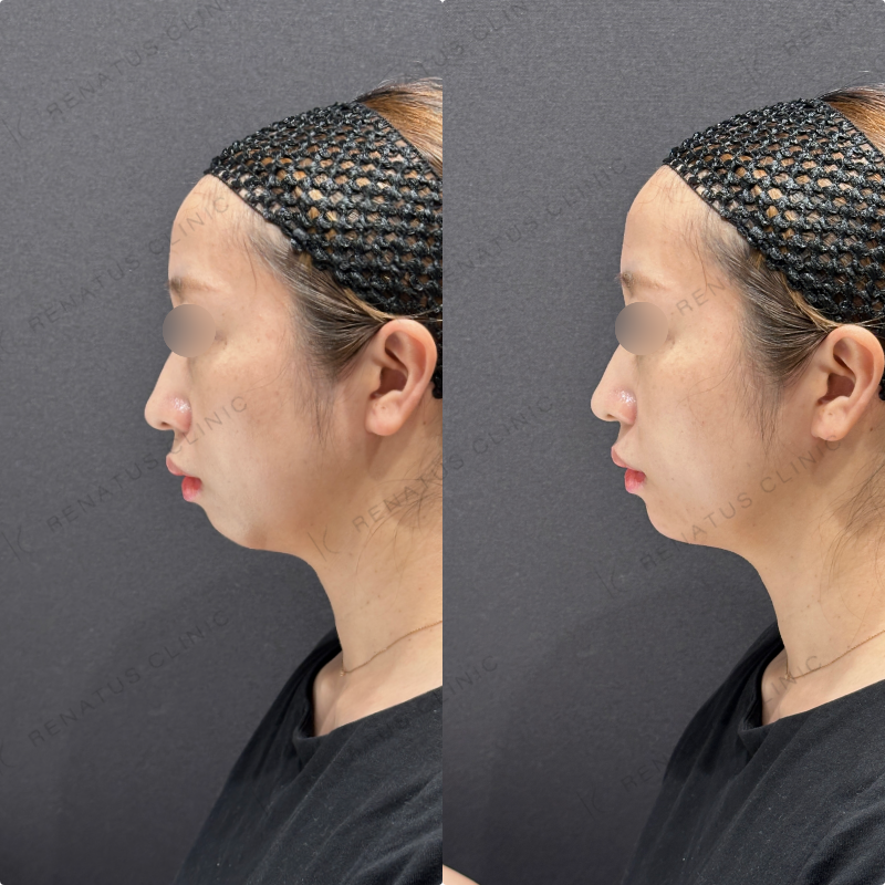 顎ヒアルロン酸ボラックス症例写真