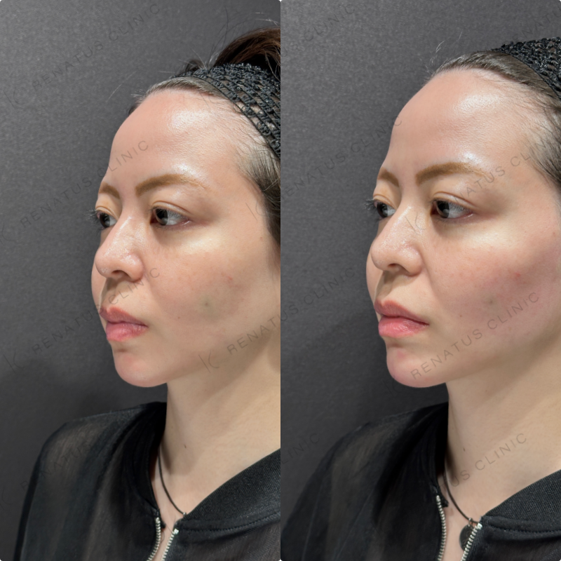 顎ヒアルロン酸ボラックス症例写真