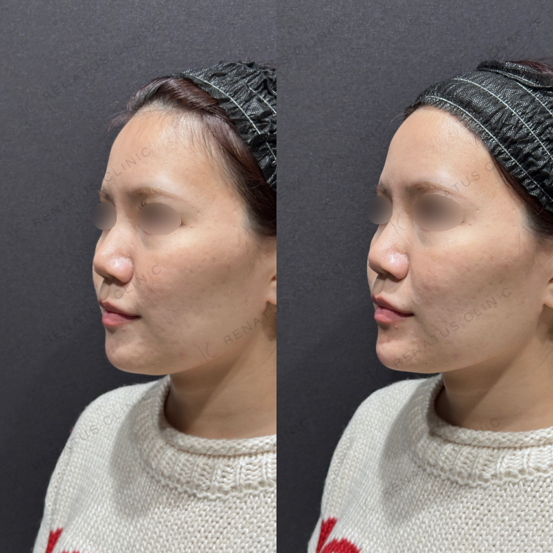 顎ヒアルロン酸ボラックス症例写真