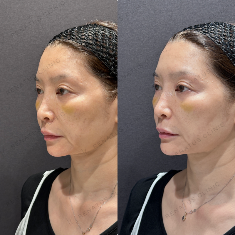 顎ヒアルロン酸ボラックス症例写真