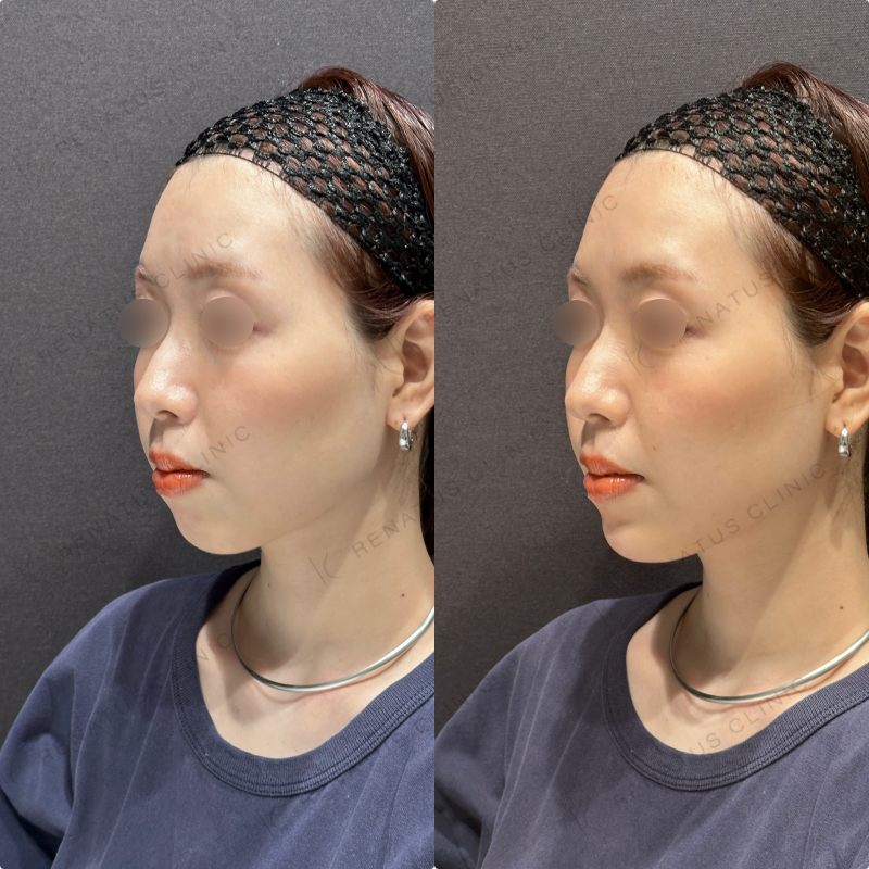 顎ヒアルロン酸ボラックス症例写真