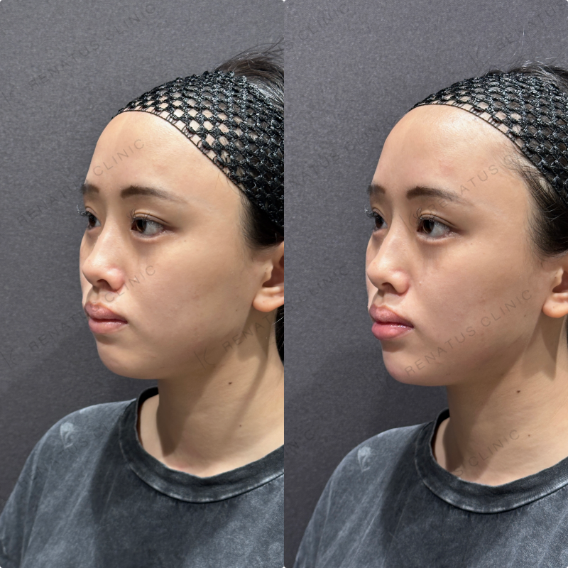 顎ヒアルロン酸ボラックス症例写真