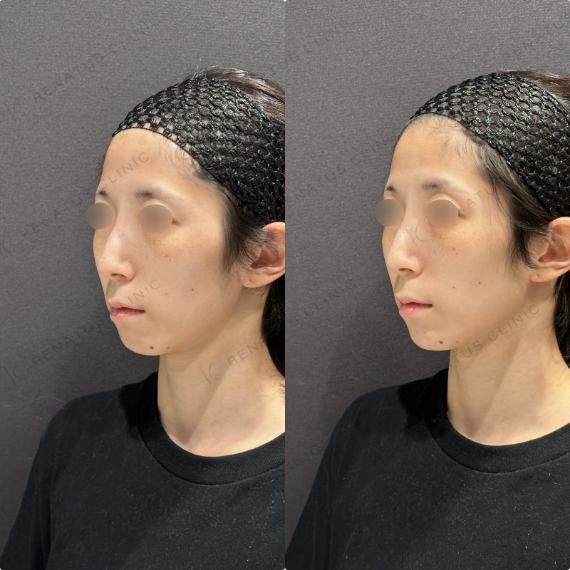 顎ヒアルロン酸ボラックス症例写真