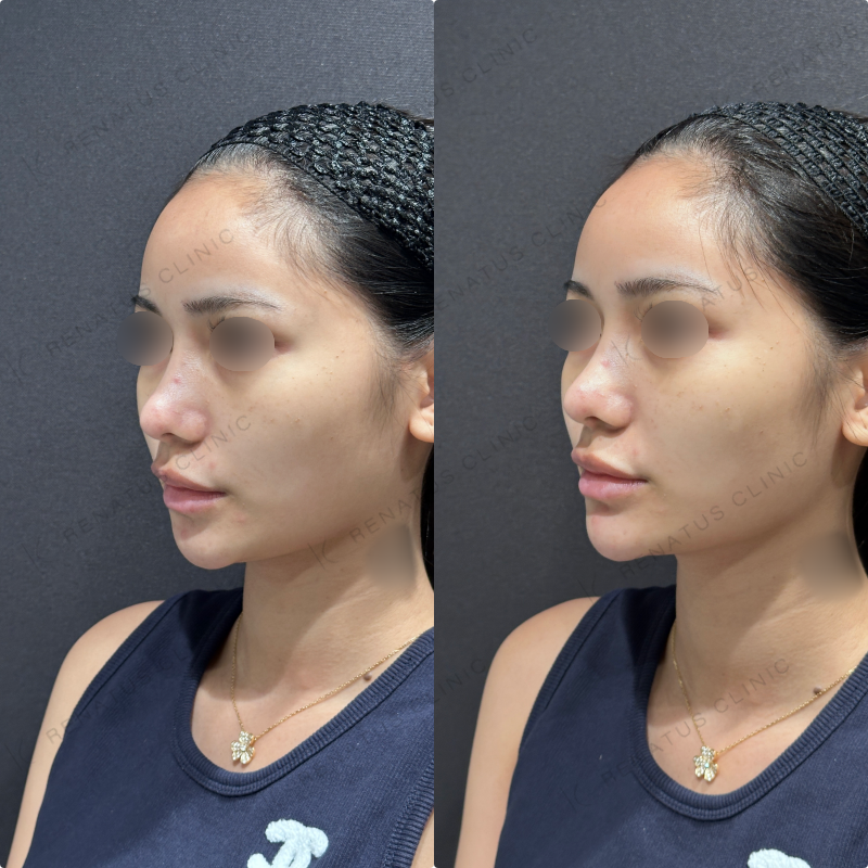 顎ヒアルロン酸ボラックス症例写真