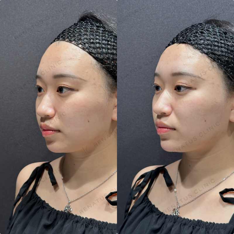 顎ヒアルロン酸ボラックス症例写真