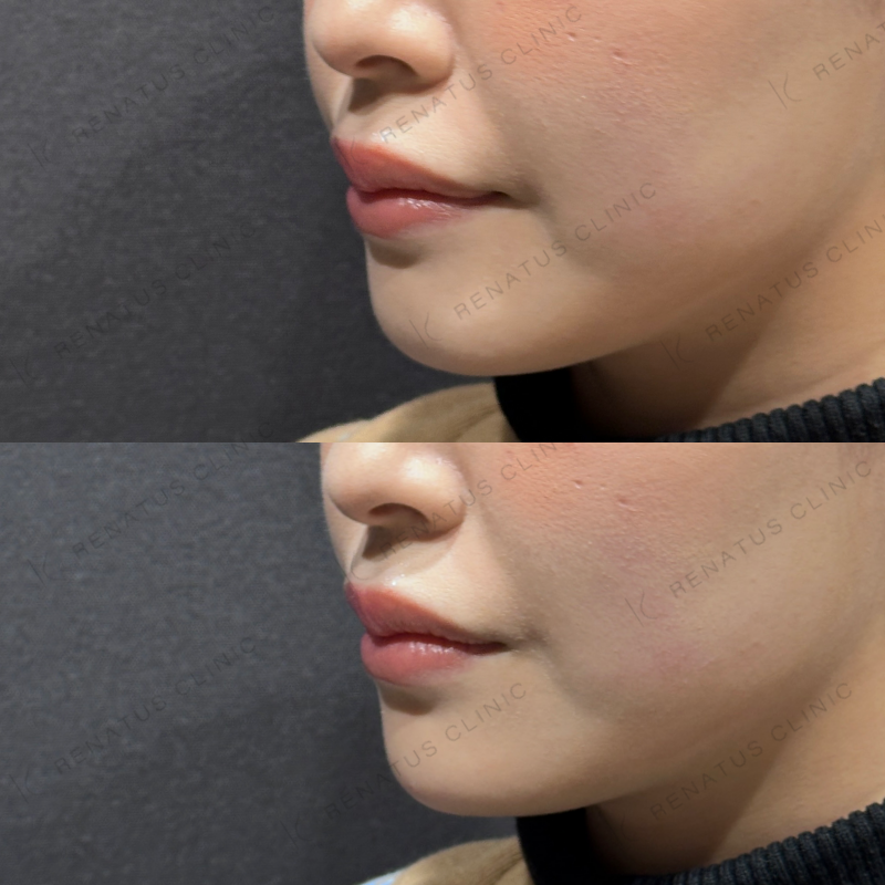 顎ヒアルロン酸ボラックス症例写真