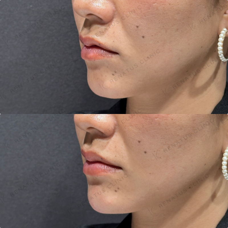 顎ヒアルロン酸ボラックス症例写真