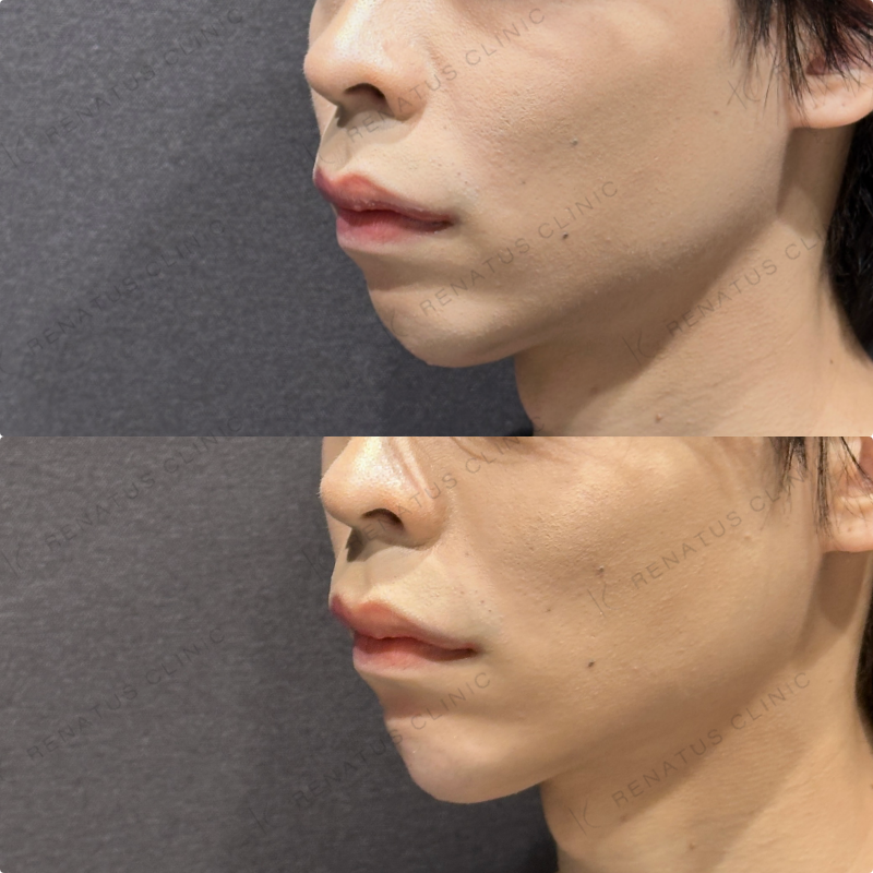 顎ヒアルロン酸ボラックス症例写真