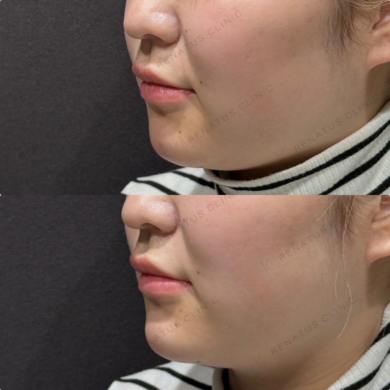 顎ヒアルロン酸ボラックス症例写真