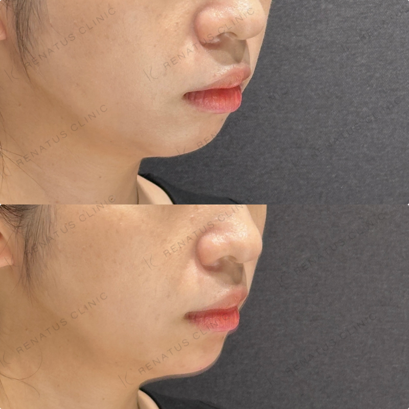 顎ヒアルロン酸ボラックス症例写真