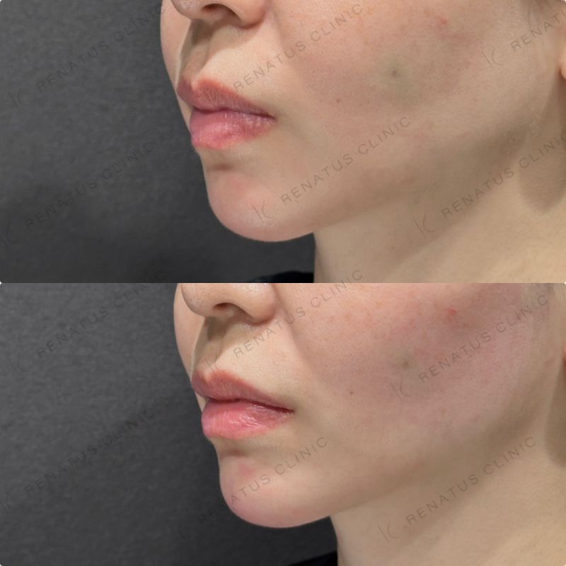 顎ヒアルロン酸ボラックス症例写真