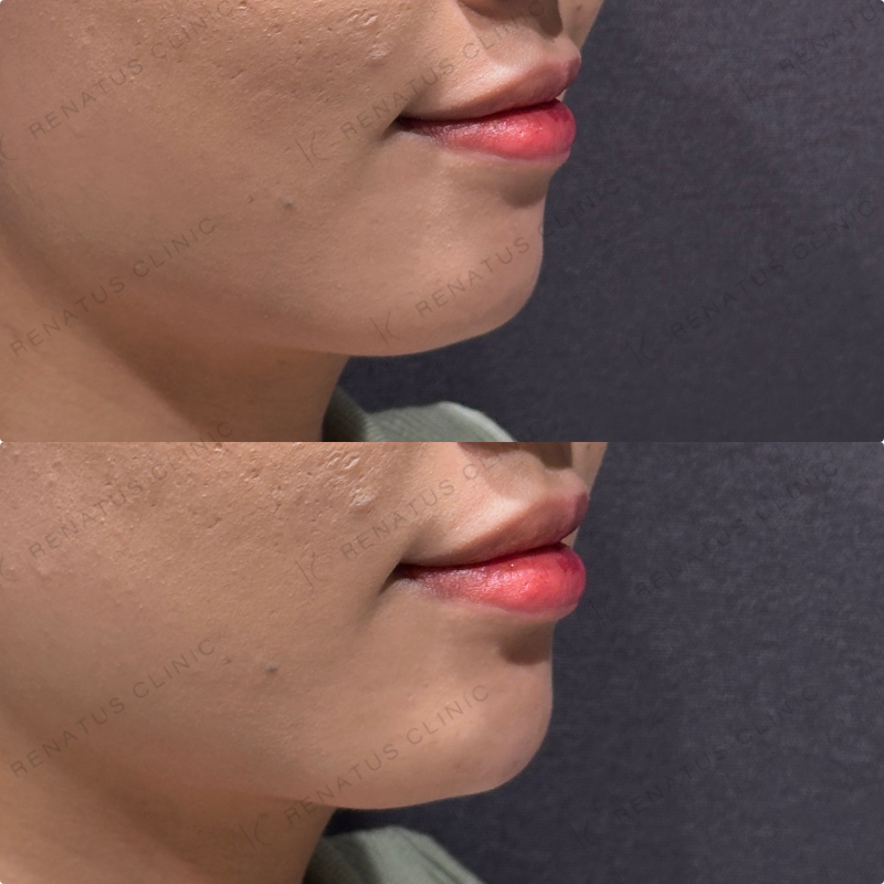 顎ヒアルロン酸ボラックス症例写真