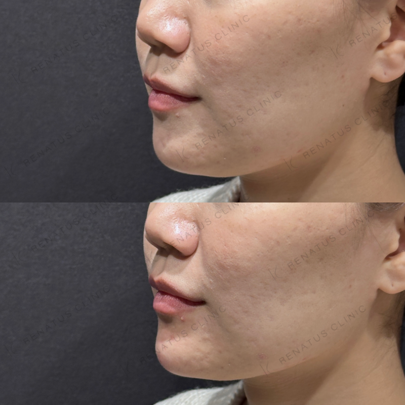 顎ヒアルロン酸ボラックス症例写真