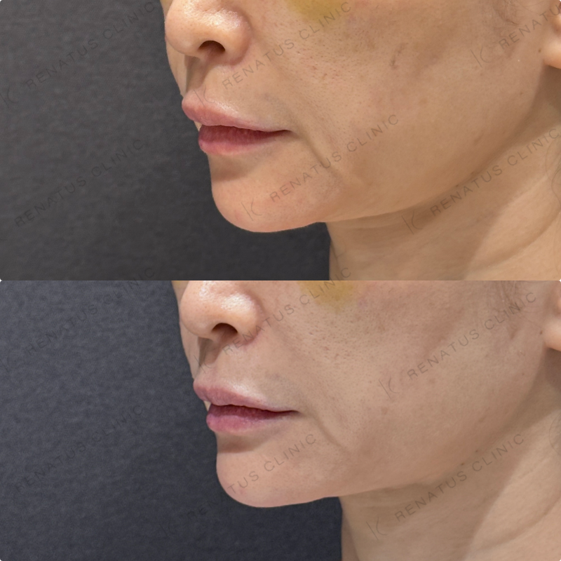 顎ヒアルロン酸ボラックス症例写真