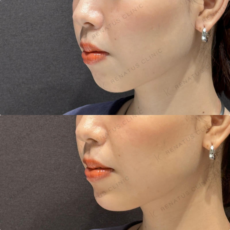 顎ヒアルロン酸ボラックス症例写真
