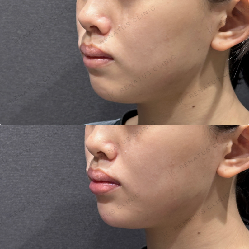 顎ヒアルロン酸ボラックス症例写真