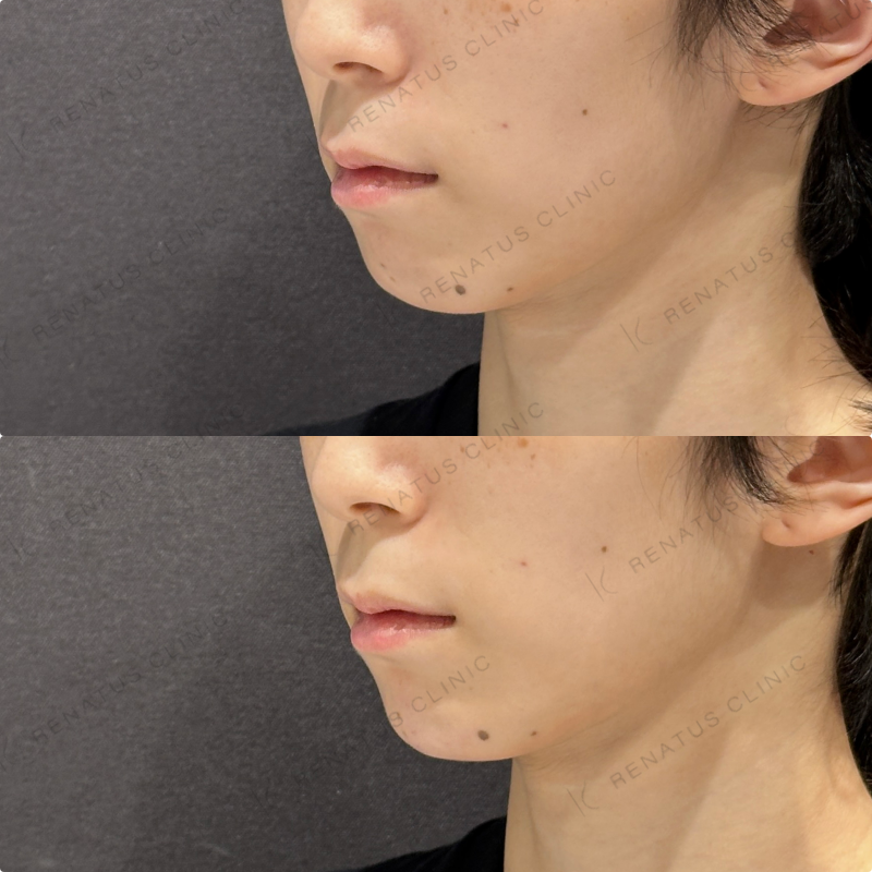 顎ヒアルロン酸ボラックス症例写真