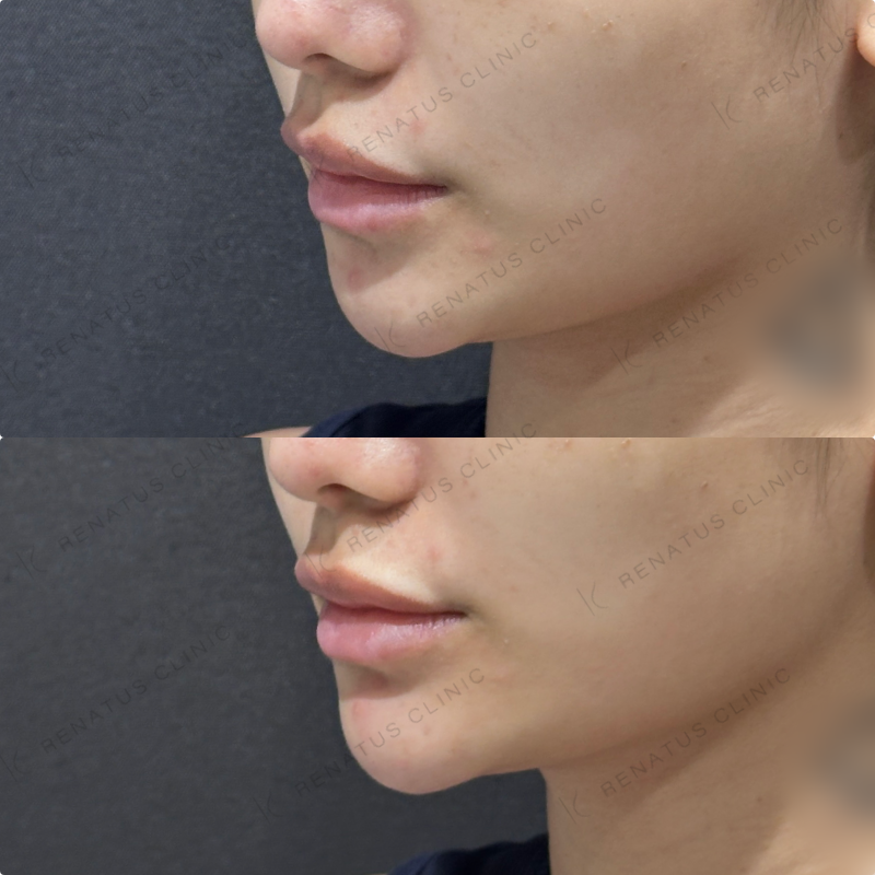 顎ヒアルロン酸ボラックス症例写真