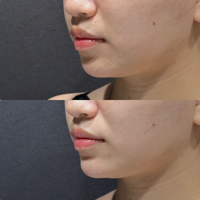 顎ヒアルロン酸ボラックス症例写真