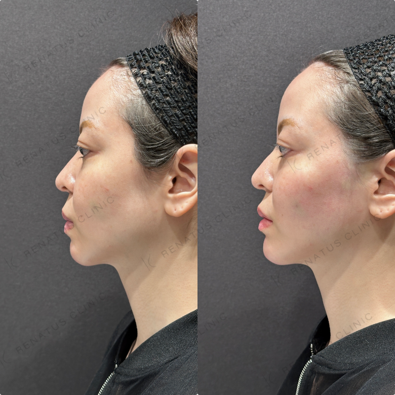 顎ヒアルロン酸ボラックス症例写真