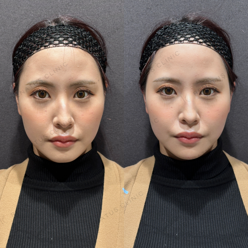 顎ヒアルロン酸ボラックス症例写真