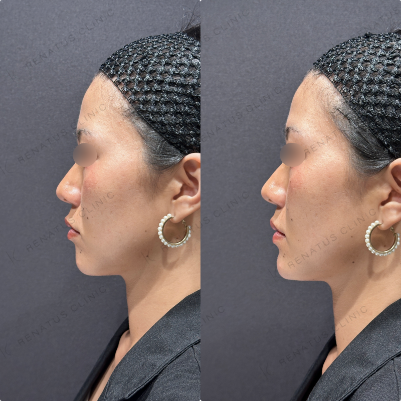 顎ヒアルロン酸ボラックス症例写真