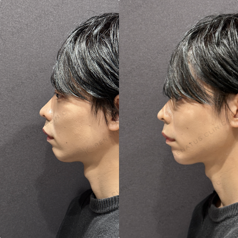 顎ヒアルロン酸ボラックス症例写真