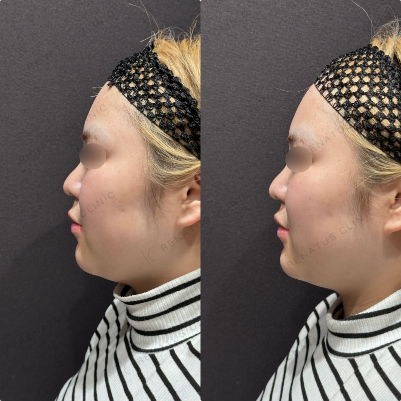 顎ヒアルロン酸ボラックス症例写真