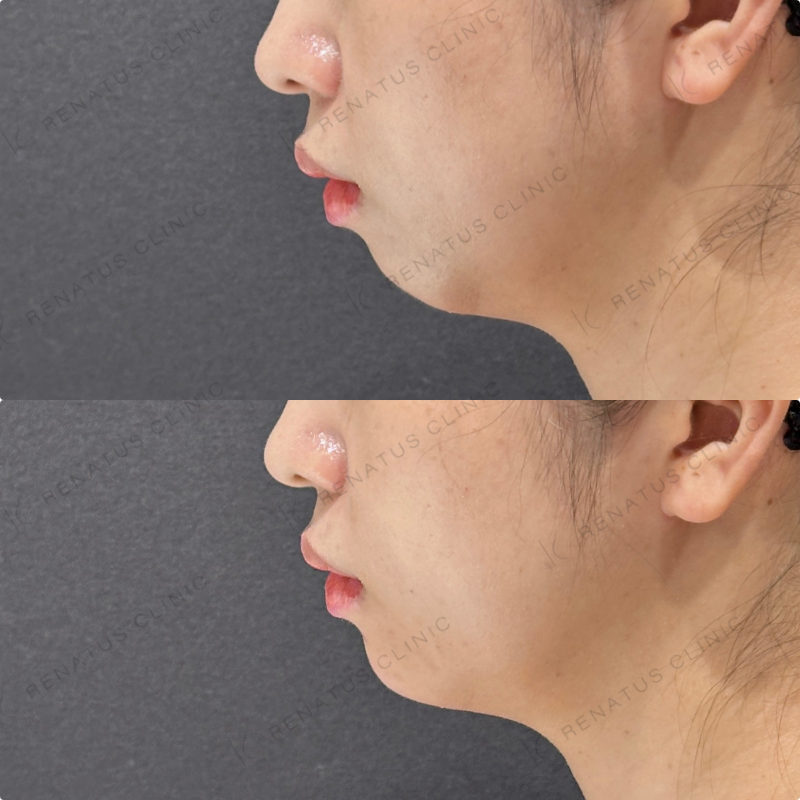 顎ヒアルロン酸ボラックス症例写真