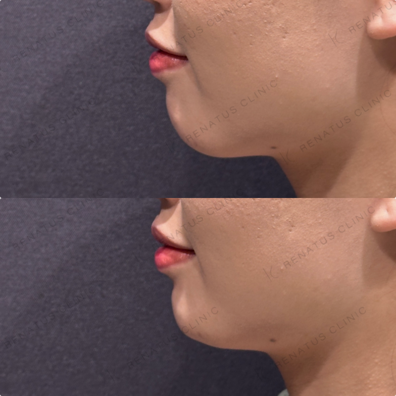 顎ヒアルロン酸ボラックス症例写真