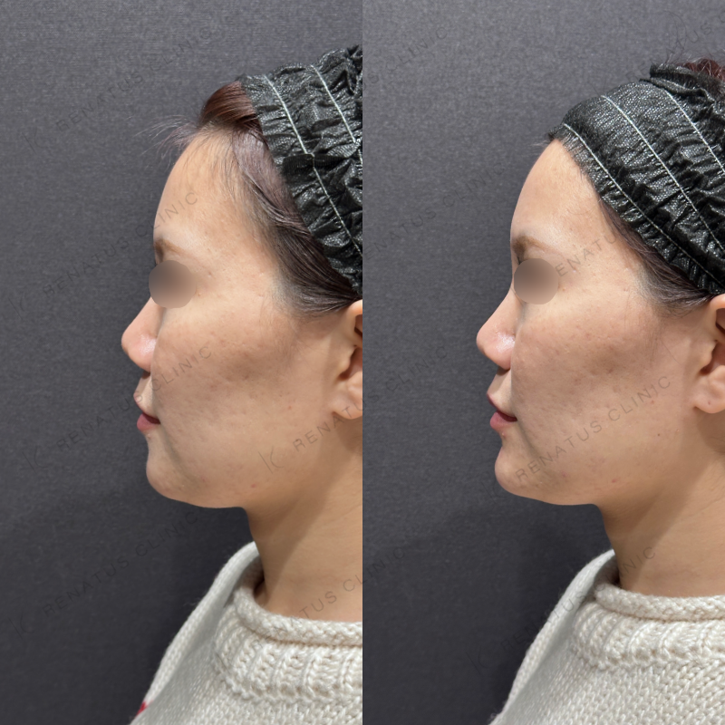 顎ヒアルロン酸ボラックス症例写真