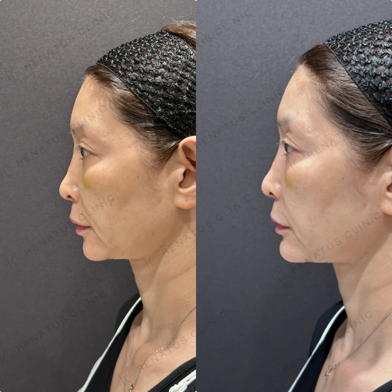 顎ヒアルロン酸ボラックス症例写真