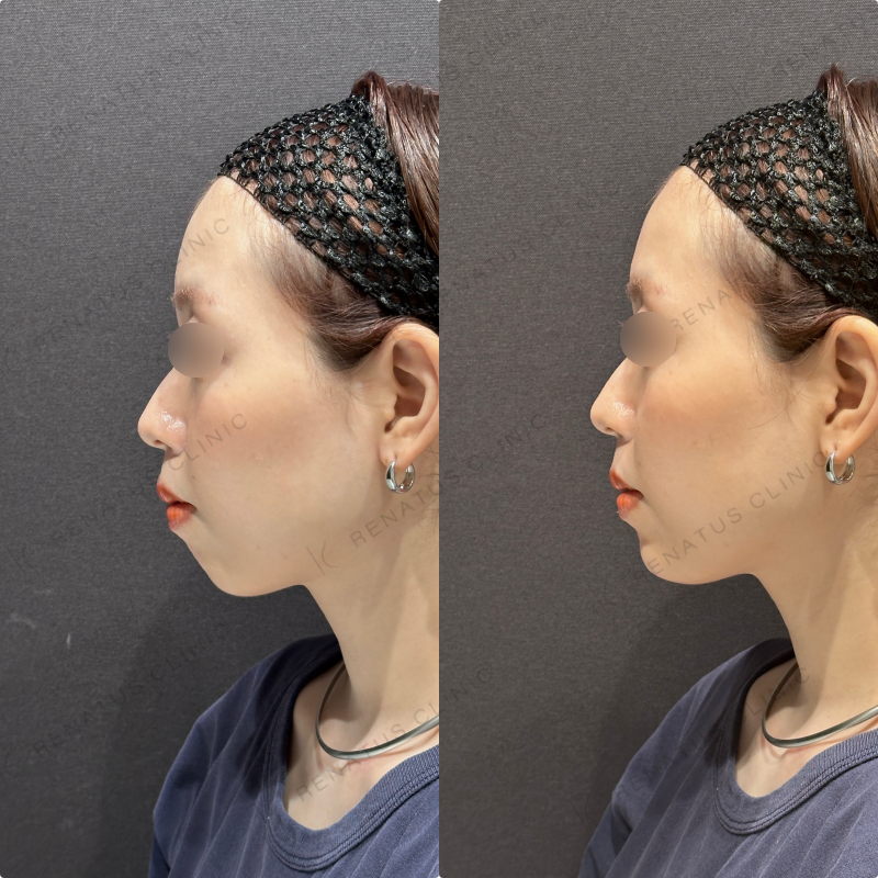 顎ヒアルロン酸ボラックス症例写真